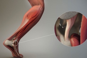 Những Chấn Thương Thường Gặp Ở Gân Và Dây Chằng Và Cách Phòng Tránh Hiệu Quả